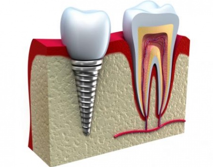 Скидка 60%! Установка Швейцарского имплантата HEXACONE компании Ihde Dental! 10620 р! Все включено!